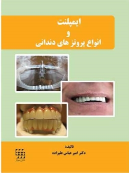 ایمپلنت و انواع پروتزهای دندانی