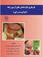 بازسازی تاج دندان های از بین رفته (انواع پست و کور)