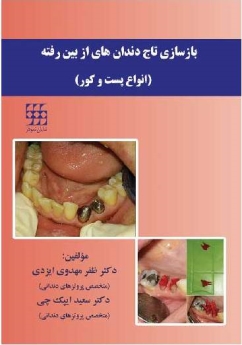 بازسازی تاج دندان های از بین رفته (انواع پست و کور)
