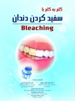 گام به گام با سفید کردن دندان (Bleaching)
