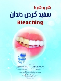 گام به گام با سفید کردن دندان (Bleaching)