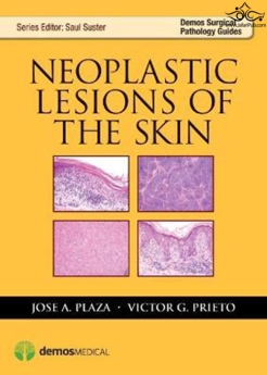 Neoplastic Lesions of the Skin2014
