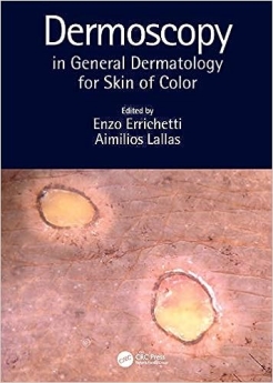 Dermoscopy in General Dermatology for Skin of Color2021